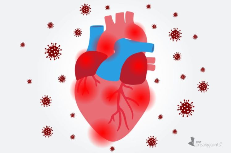 Di chứng tim mạch hậu COVID-19: Làm sao để giảm nhẹ?